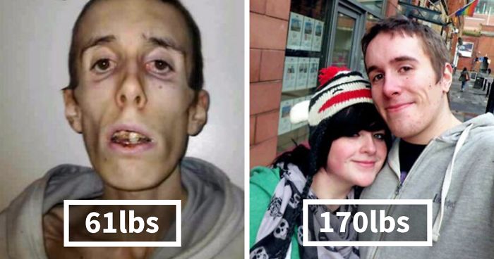 Before After Photos Of People Who Beat Anorexia True Activist