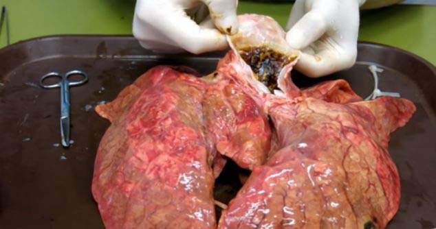 This Is What Happens To Lungs After Smoking 60 Cigarettes True Activist