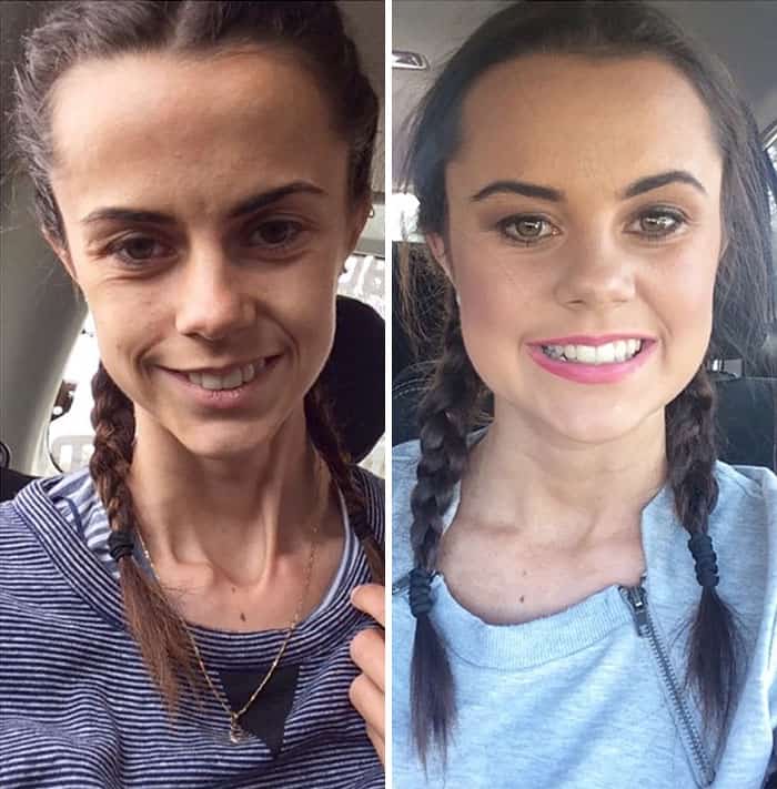 45 ‘Before & After’ Photos Of People Who Beat Anorexia - True Activist