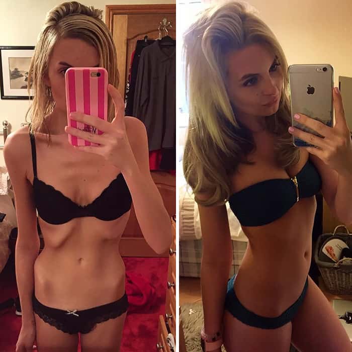 45 ‘before And After’ Photos Of People Who Beat Anorexia