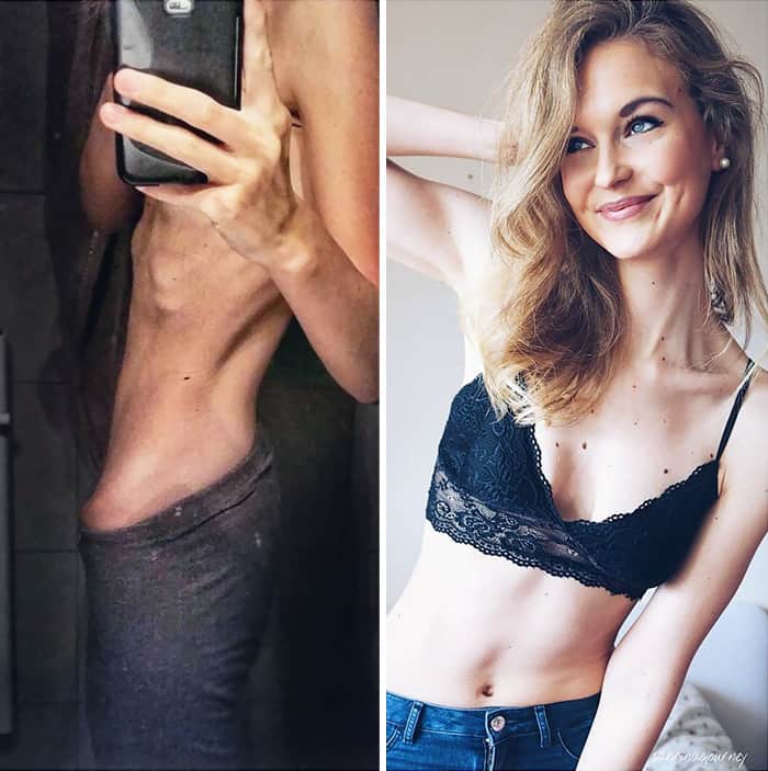 45 ‘before And After’ Photos Of People Who Beat Anorexia