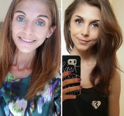 45 ‘Before & After’ Photos Of People Who Beat Anorexia - True Activist