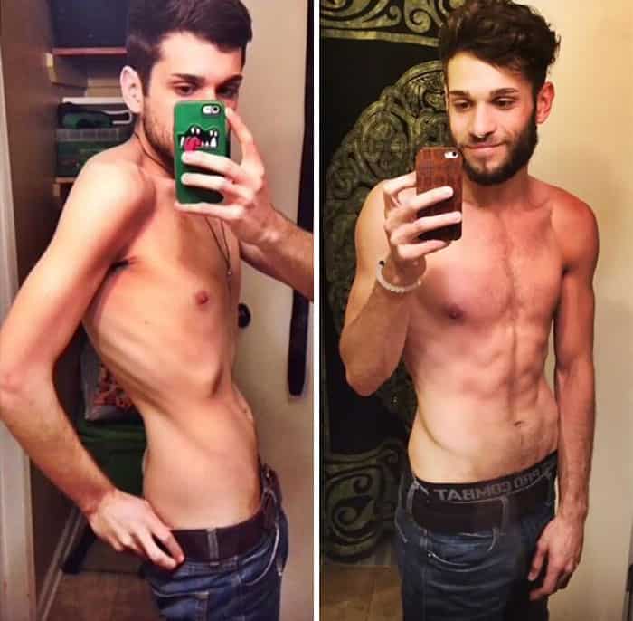 45 Before After Photos Of People Who Beat Anorexia True Activist