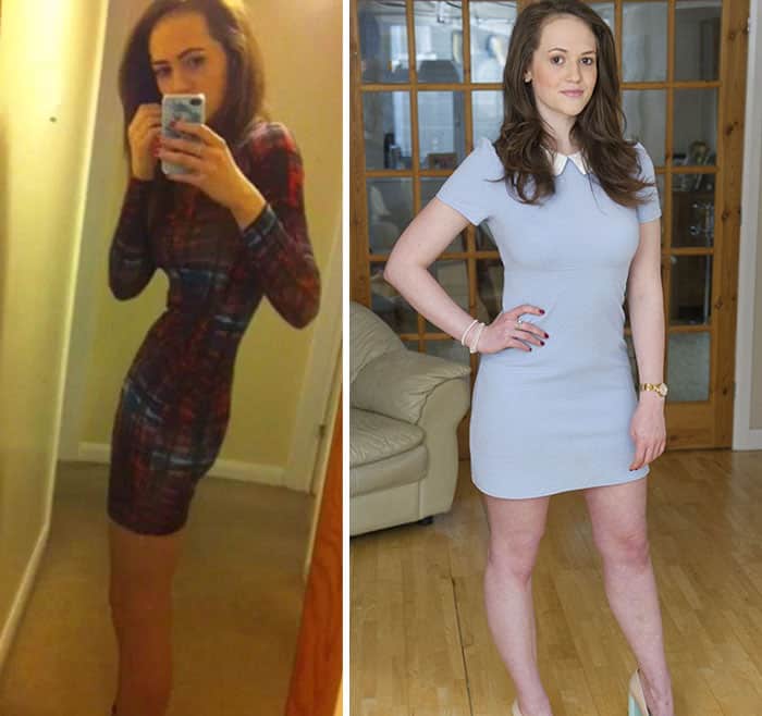 45 ‘before And After’ Photos Of People Who Beat Anorexia