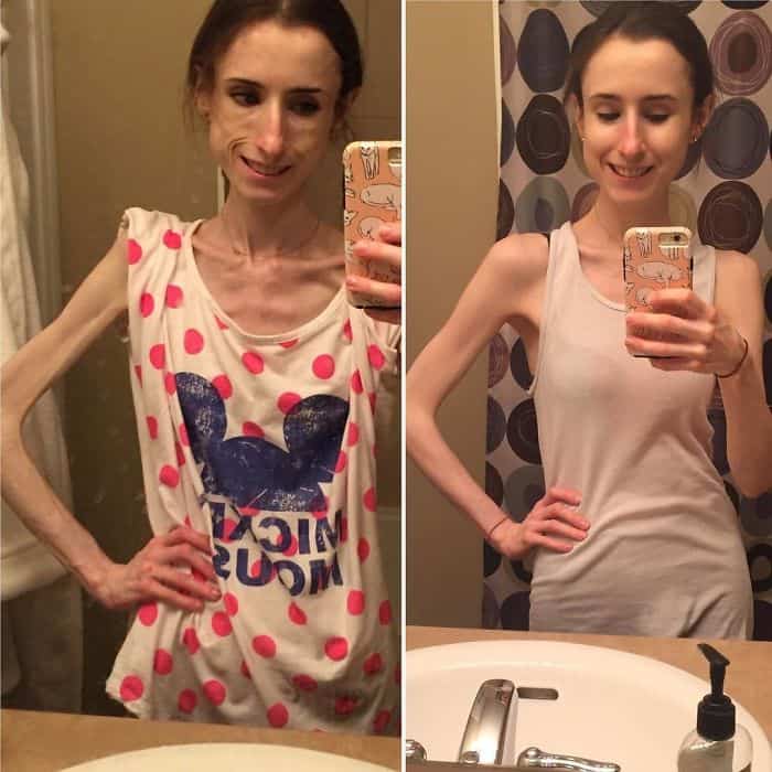 45 ‘before And After’ Photos Of People Who Beat Anorexia