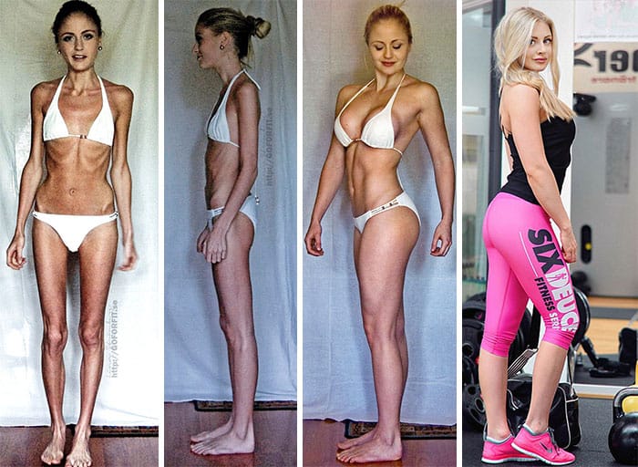 45 ‘before And After’ Photos Of People Who Beat Anorexia