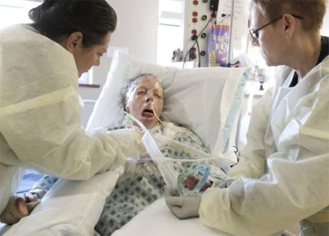 She Suffered For 2 Years After Boyfriend Lit Her On Fire, And Now She