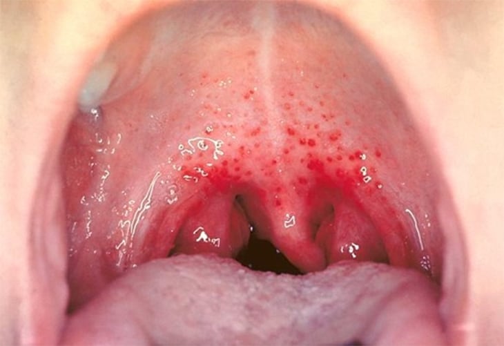 in throat Adult sore