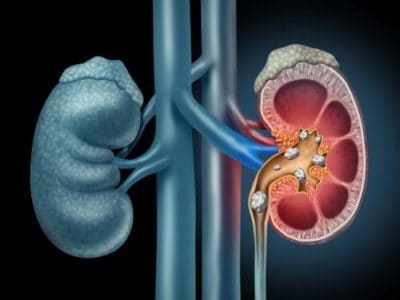 Kidney Stones: Causes, Treatments and How To Prevent Them - Page 8 of